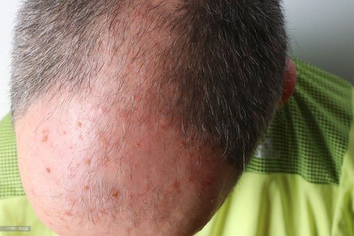Why does actinic keratosis happen?