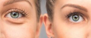 What are Bags under eyes causes and Permanent Treatment?