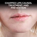 Chapped lips Causes, Treatment, and Prevention
