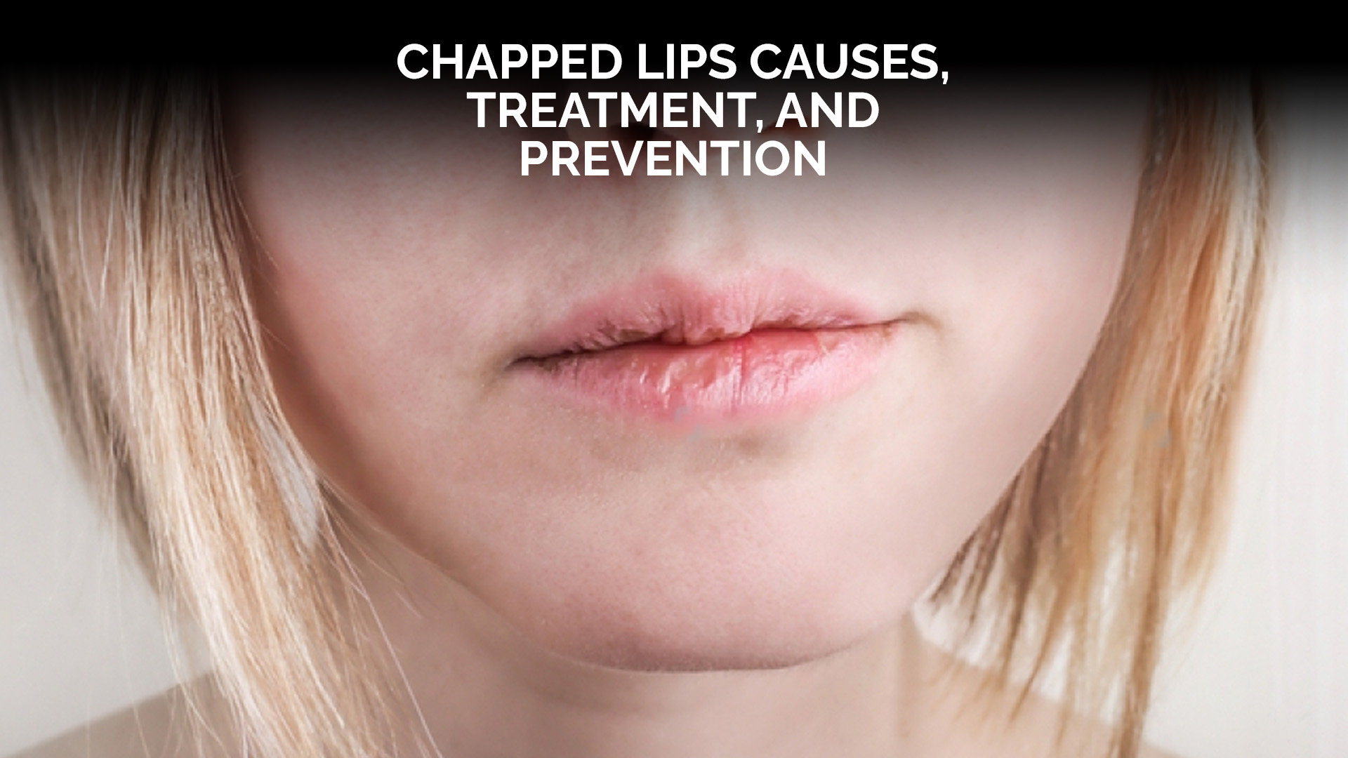 Chapped lips Causes, Treatment, and Prevention