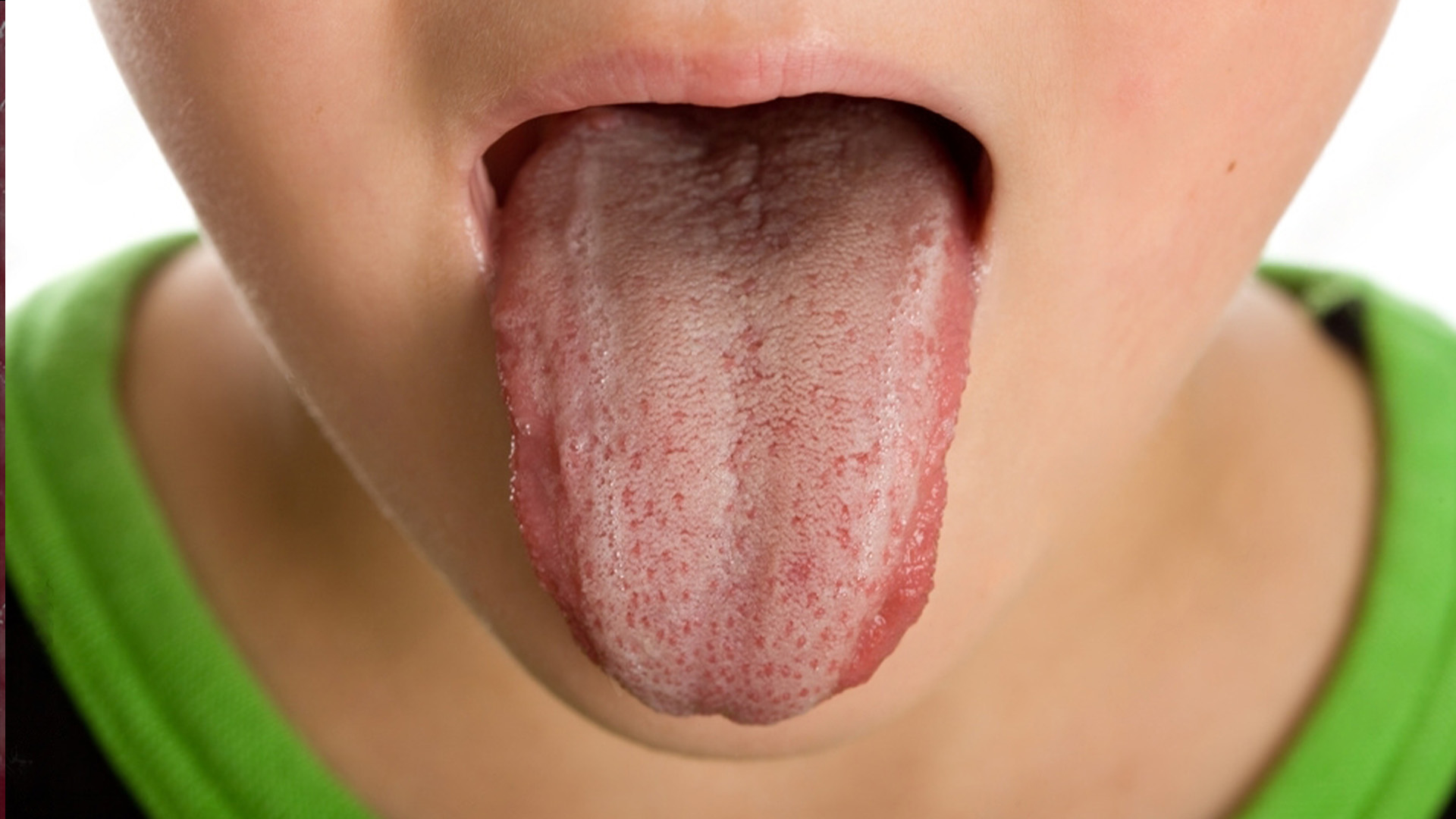 Red Bumps On Tongue Back Top 10 Causes Easy Peasy 