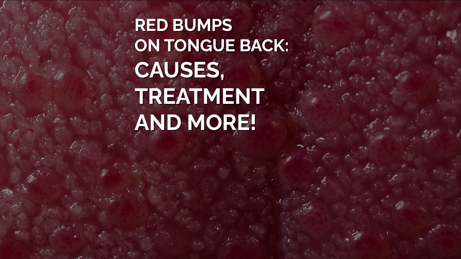 Red Bumps On Tongue Back: Causes, Treatment and more!
