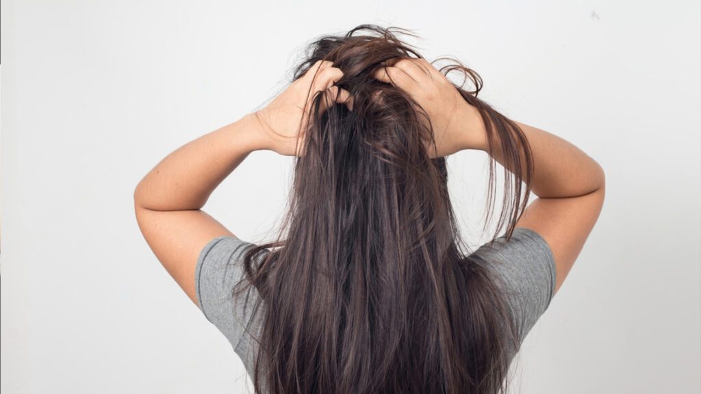 What Are Some Home Remedies for Dry Scalp and Dandruff?