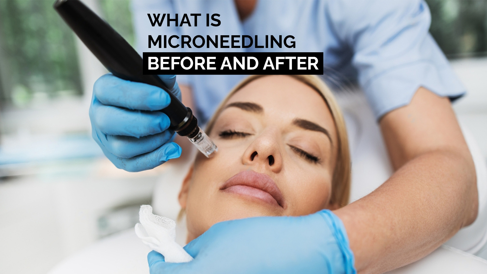 What Is Microneedling Before And After