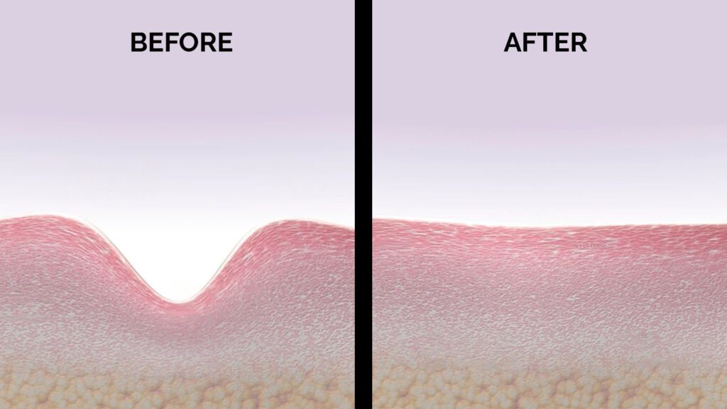 What Is The Difference Between Micro needling Before And After 1 Treatment