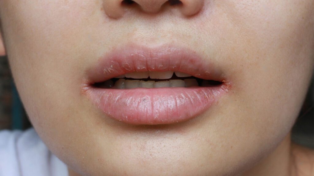 What are the Symptoms of Chapped Lips-Chapped Lips Causes