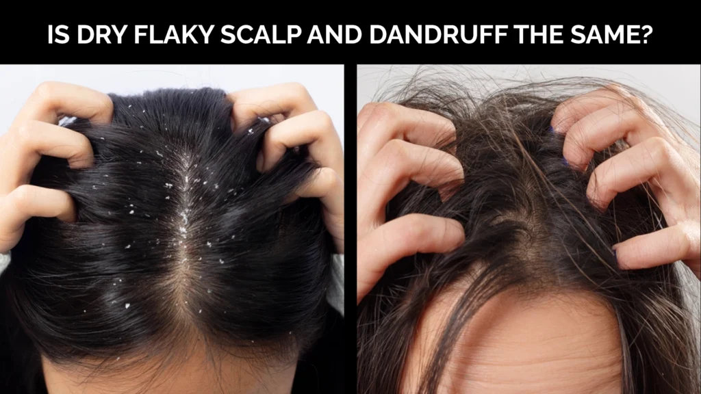 Is Dry Flaky Scalp And Dandruff The Same?