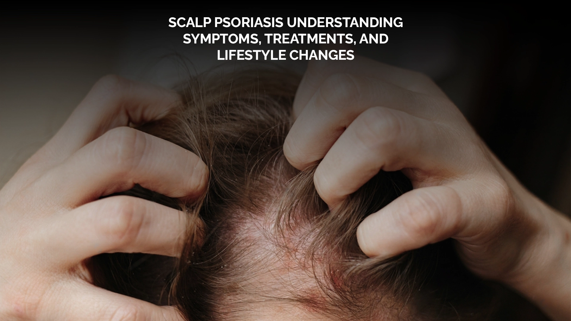 Scalp Psoriasis Understanding Symptoms, Treatments, and Lifestyle Changes