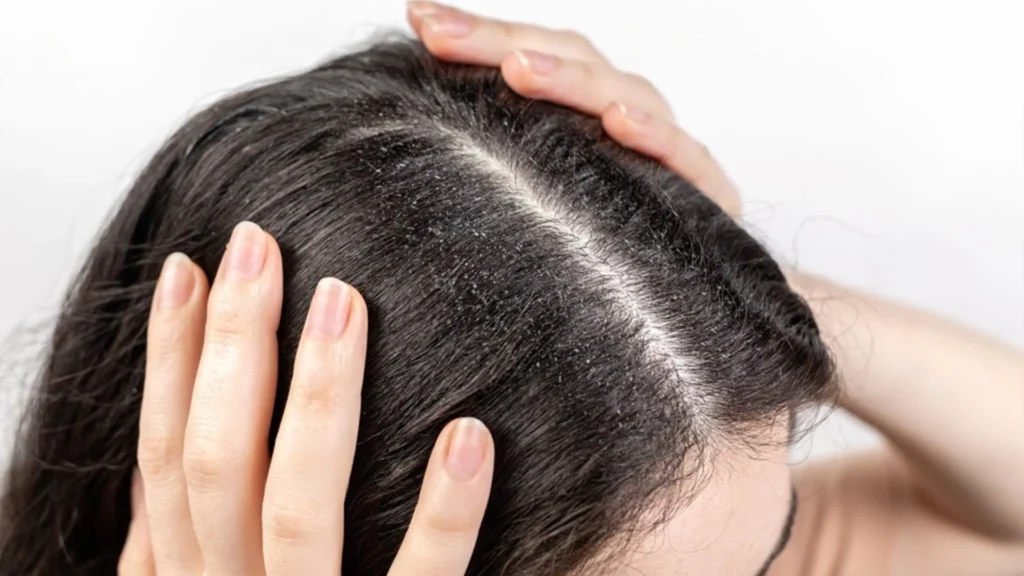 
the steps that can reduce the chances of Scalp Psoriasis Causes