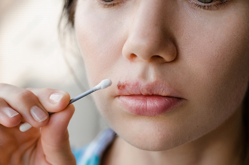 How to get rid of pimple on lip line treatment 