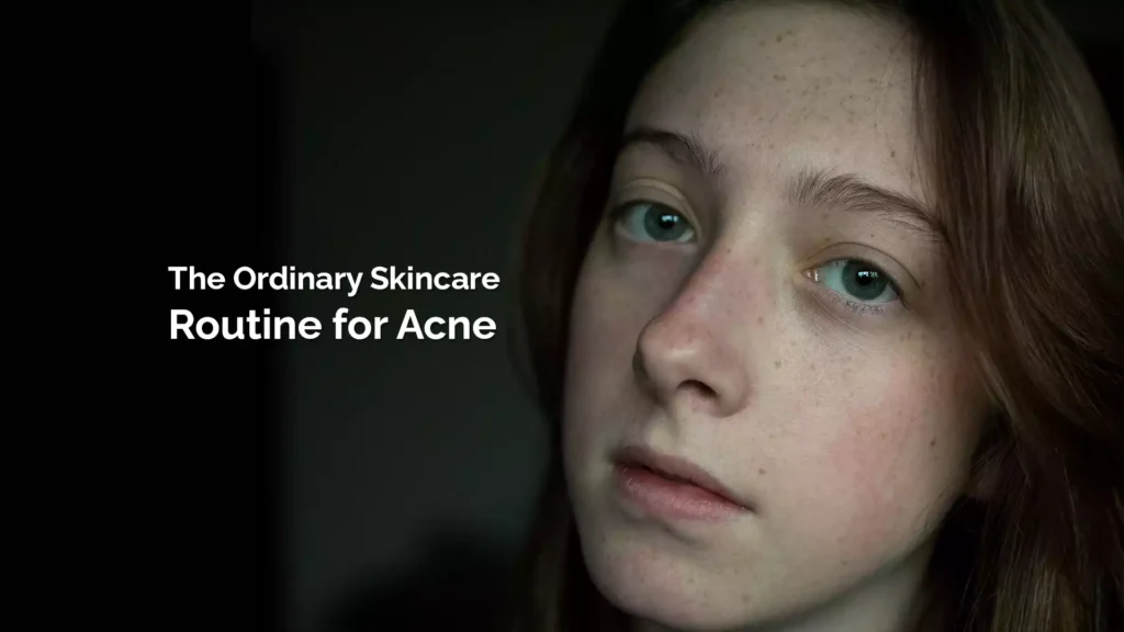 The Ordinary Skincare Routine for Acne 