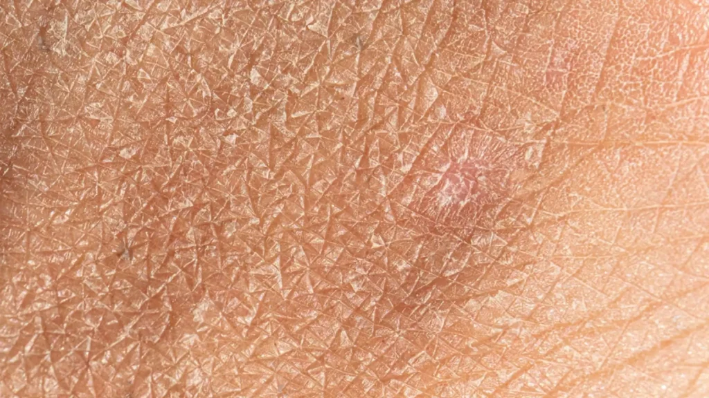 Understanding Dry Skin