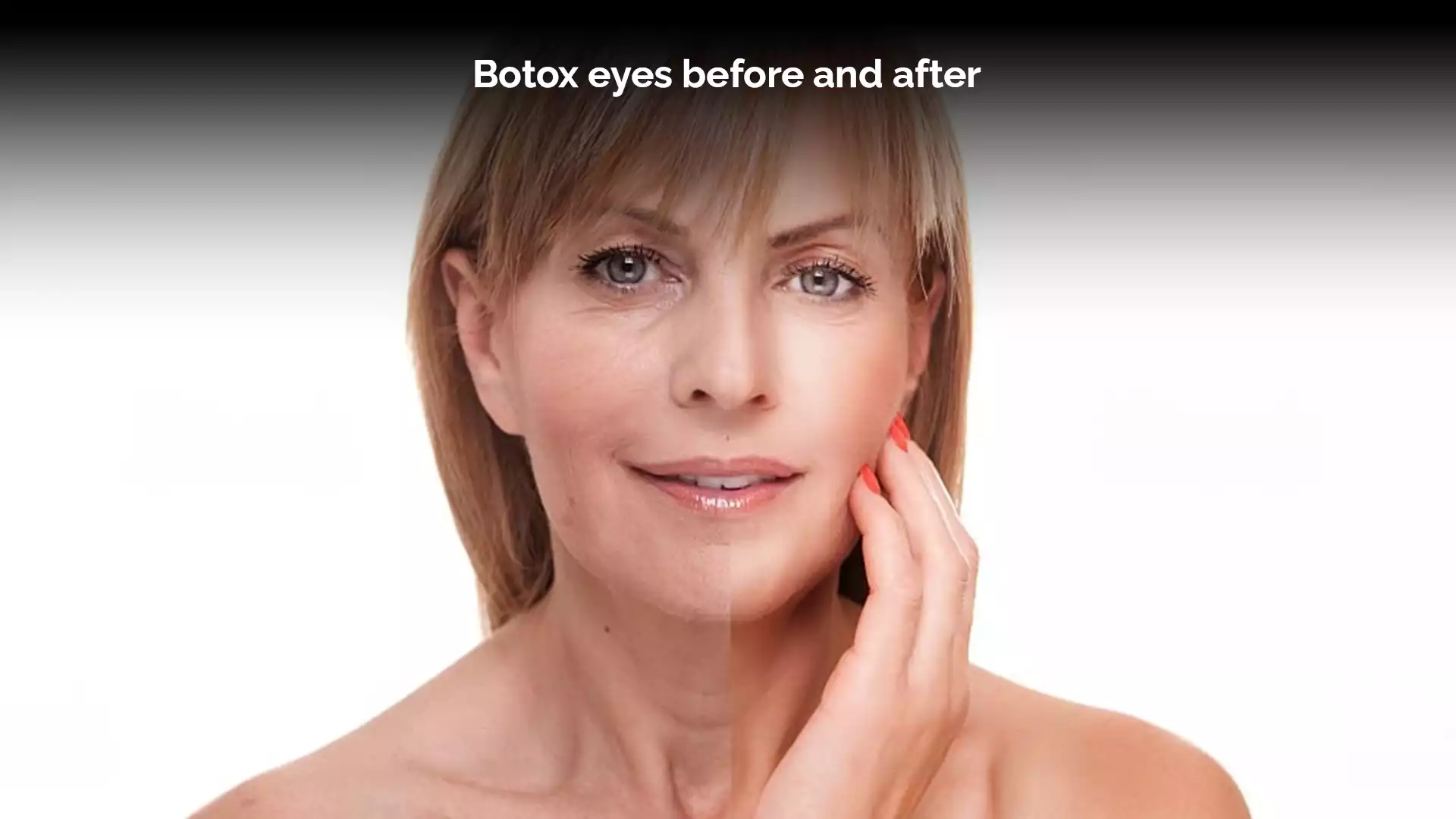 Botox eyes before and after