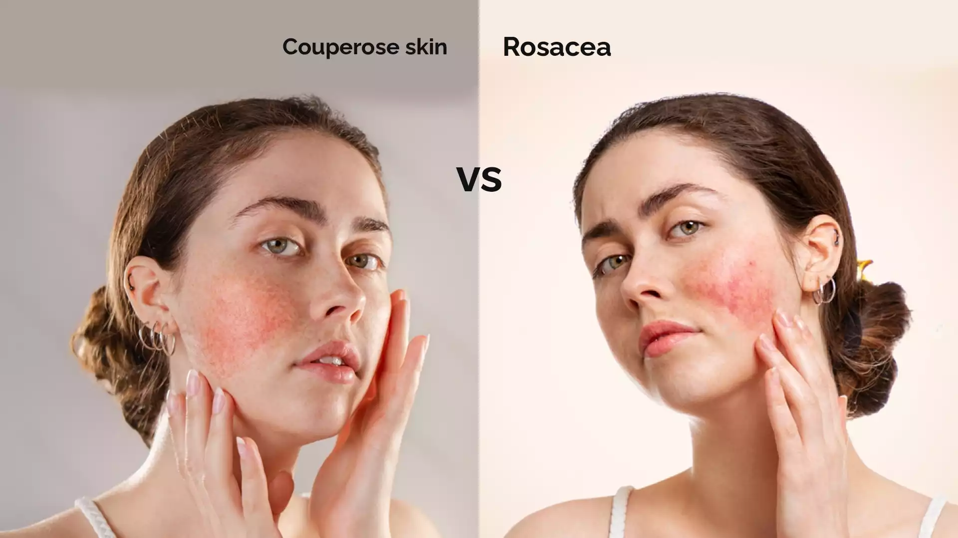 Couperose skin vs Rosacea