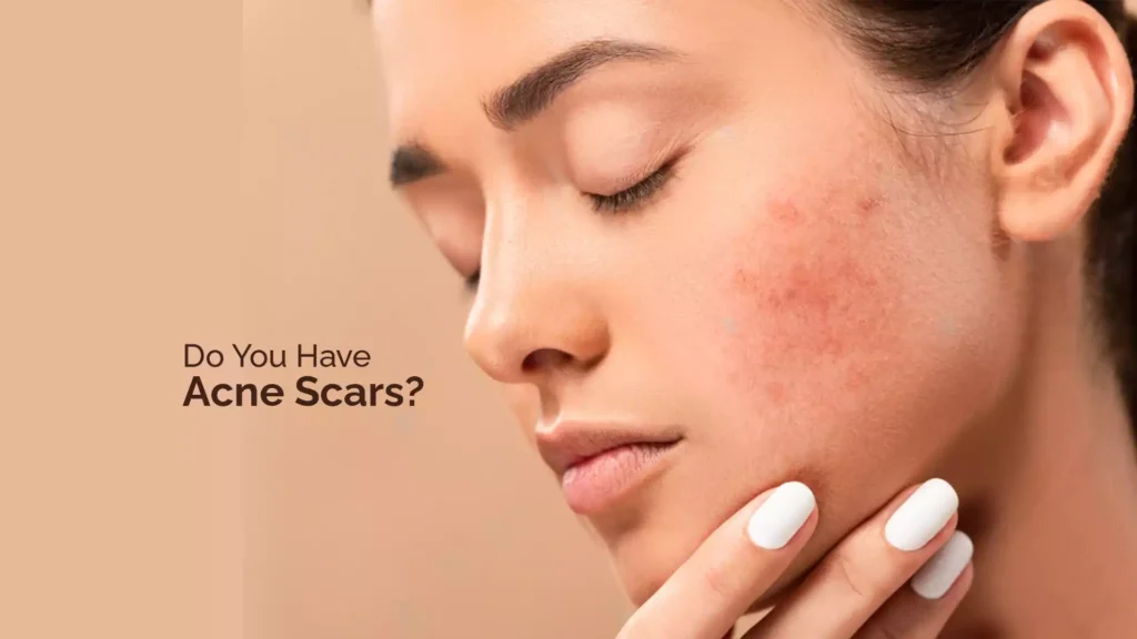 Do You Have Acne Scars?