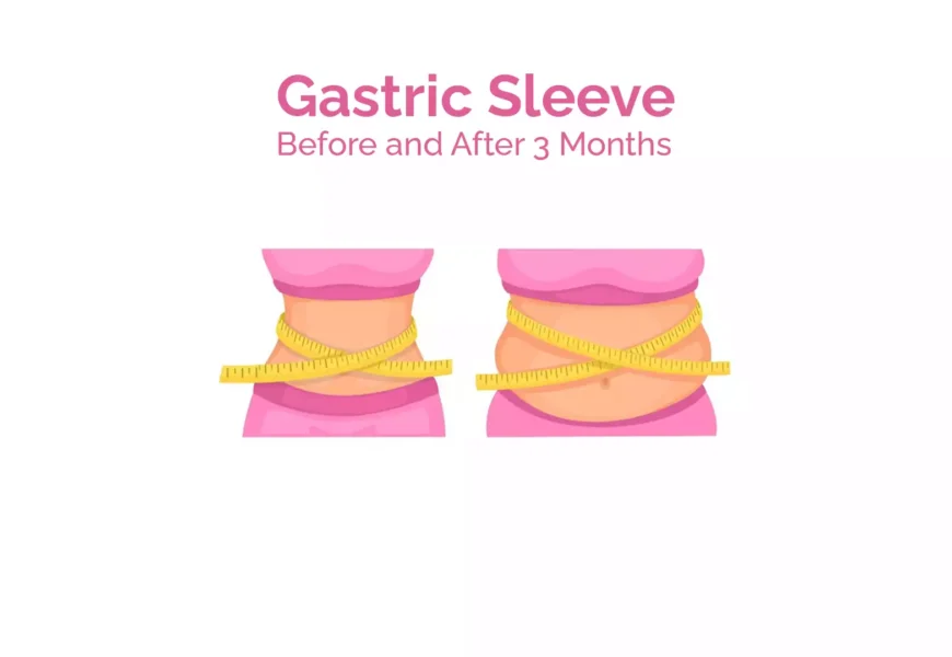 Gastric Sleeve Before And After 3 Months Results Easy Peasy 6671
