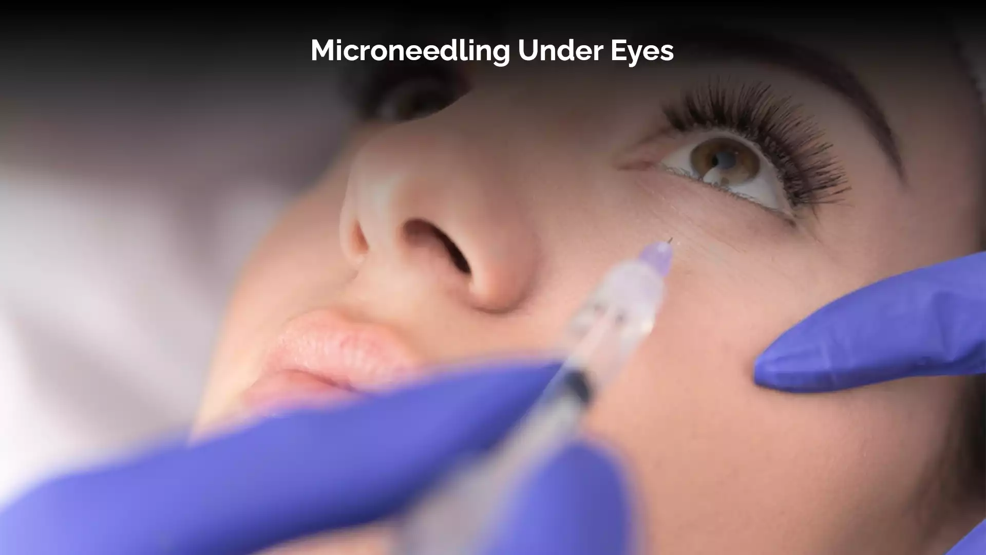 Microneedling Under Eyes