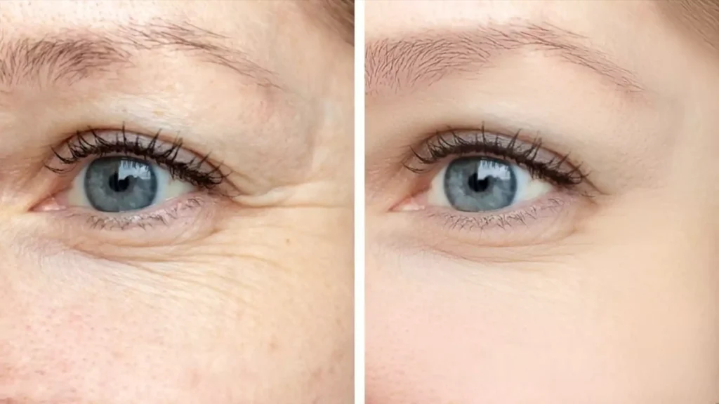 What is Botox for Under-Eye Wrinkles?