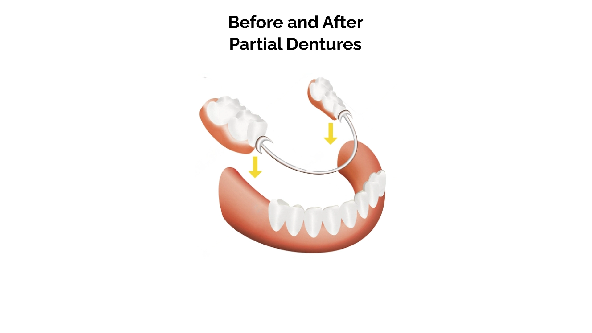 Before and After Partial Dentures