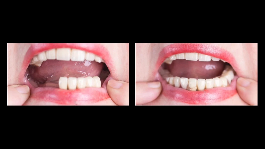 Images Of Partial Dentures Front Teeth Before And After